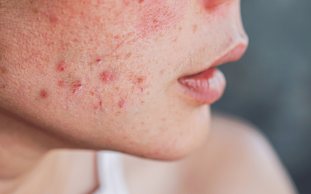 “Daily Rituals for Acne-Prone Skin” – Tips praktis menggunakan Acne Spot Treatment & Hydrating Toner