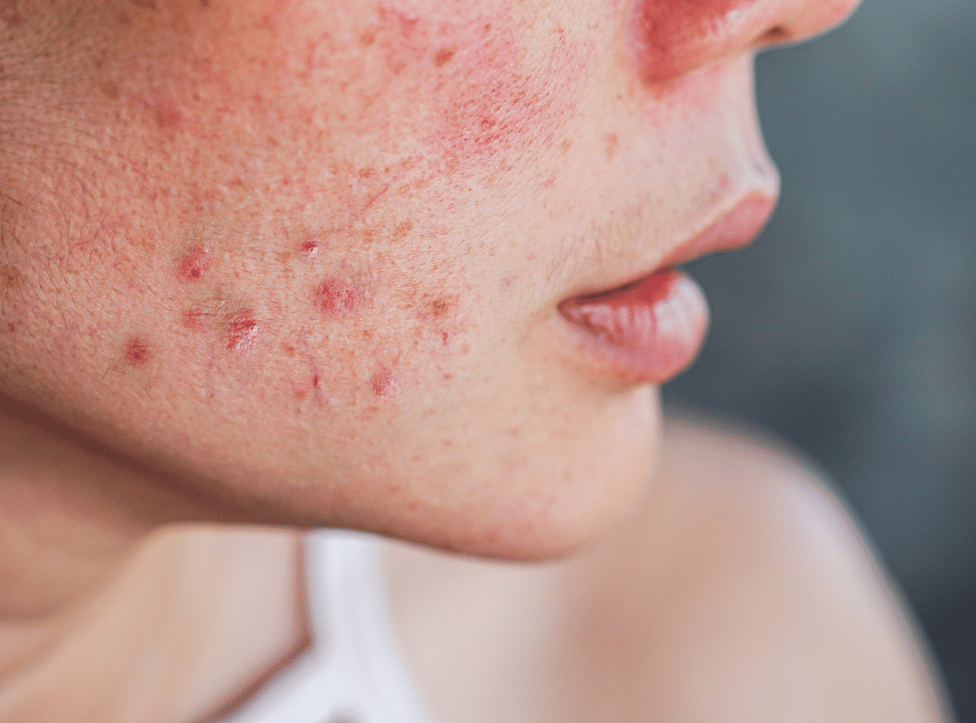 “Daily Rituals for Acne-Prone Skin” – Tips praktis menggunakan Acne Spot Treatment & Hydrating Toner